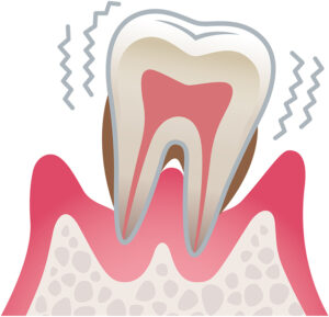 歯周病重度症状のイラスト