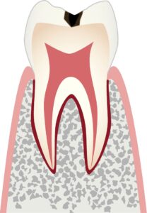 エナメル質に小さな穴が開いたむし歯のイラスト