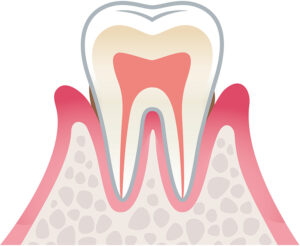 歯周病軽度症状のイラスト