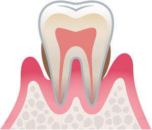歯周病中度症状のイラスト